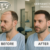 Beste Haartransplantation Klinik