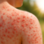 Sonnenallergie Ursachen Symptome Bahndlung