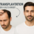 Wie lange bleiben Haare nach Haartransplantation